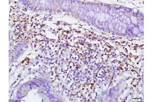 Paraformaldehyde-fixed, paraffin embedded human colon carcinoma, Antigen retrieval by boiling in sodium citrate buffer (pH6) for 15min, Block endogenous peroxidase by 3% hydrogen peroxide for 30 minutes, Blocking buffer (normal goat serum) at 37°C for 20min, Antibody incubation with 	CD10 Polyclonal Antibody, Unconjugated  at 1:500 overnight at 4°C, followed by a conjugated secondary and DAB staining