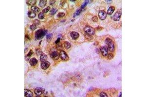 Immunohistochemical analysis of GABRD staining in human lung cancer formalin fixed paraffin embedded tissue section.