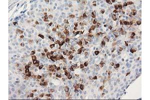 Immunohistochemical staining of paraffin-embedded Adenocarcinoma of Human breast tissue using anti-MGLL mouse monoclonal antibody. (MGLL anticorps)