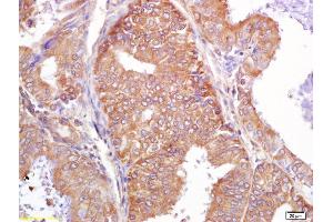 Formalin-fixed and paraffin embedded human breast carcinoma labeled with Rabbit Anti PALB2 Polyclonal Antibody, Unconjugated (ABIN670536) at 1:200 followed by conjugation to the secondary antibody and DAB staining (PALB2 anticorps  (AA 1101-1186))