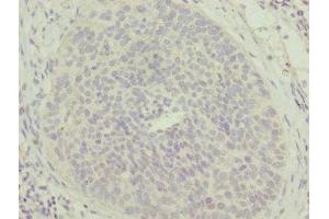 Immunohistochemistry of paraffin-embedded human cervical cancer using ABIN7159869 at dilution of 1:100 (Mtfp1 anticorps  (AA 1-166))