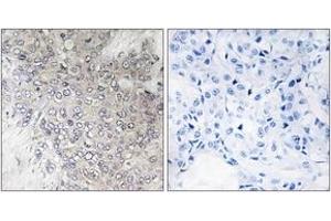 Immunohistochemistry analysis of paraffin-embedded human breast carcinoma, using p70 S6 Kinase (Phospho-Thr421) Antibody.