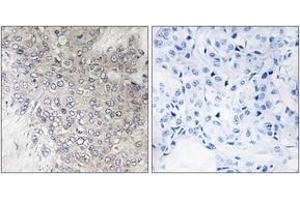 Immunohistochemistry analysis of paraffin-embedded human breast carcinoma, using p70 S6 Kinase (Phospho-Thr421) Antibody. (RPS6KB1 anticorps  (pThr444))