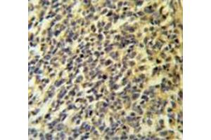 Immunohistochemistry analysis in testis carcinoma (Formalin-fixed, Paraffin-embedded) using PLA2G6  Antibody , followed by peroxidase conjugated secondary antibody and DAB staining.
