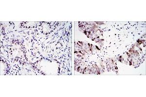 Immunohistochemical analysis of paraffin-embedded lung cancer (left) and ovary tumour tissues (right) using CCNB1 antibody with DAB staining. (Cyclin B1 anticorps)