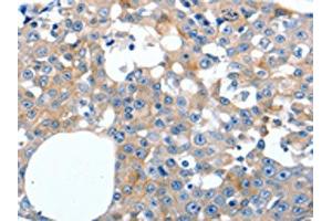 The image on the left is immunohistochemistry of paraffin-embedded Human breast cancer tissue using ABIN7191279(LILRB3 Antibody) at dilution 1/20, on the right is treated with synthetic peptide. (LILRB3 anticorps)