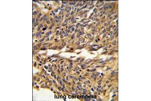 Formalin-fixed and paraffin-embedded human lung carcinoma reacted with EXOC5 Antibody , which was peroxidase-conjugated to the secondary antibody, followed by DAB staining.