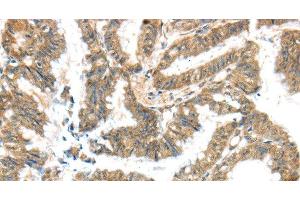 Immunohistochemistry of paraffin-embedded Human colon cancer tissue using KCNG3 Polyclonal Antibody at dilution 1:40 (KCNG3 anticorps)