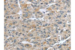 The image on the left is immunohistochemistry of paraffin-embedded Human liver cancer tissue using ABIN7190228(CFAP45 Antibody) at dilution 1/25, on the right is treated with synthetic peptide. (CCDC19 anticorps)