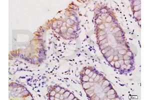 Formalin-fixed and paraffin embedded human colon carcinoma labeled with Anti-HMGA1/HMG-I/HMG-Y Polyclonal Antibody, Unconjugated (ABIN736626) at 1:200 followed by conjugation to the secondary antibody and DAB staining.