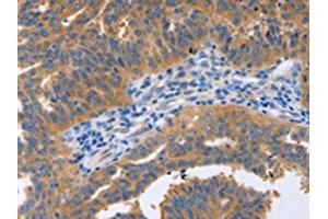 The image on the left is immunohistochemistry of paraffin-embedded Human ovarian cancer tissue using ABIN7191576(NBEA Antibody) at dilution 1/60, on the right is treated with synthetic peptide. (Neurobeachin anticorps)