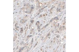 Immunohistochemical staining (Formalin-fixed paraffin-embedded sections) of human breast cancer with CDK5RAP2 monoclonal antibody, clone CL3392  shows centrosome-like immunoreactivity in tumor cells. (CDK5RAP2 anticorps)