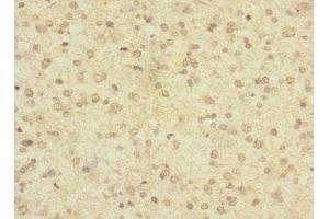 Immunohistochemistry of paraffin-embedded human glioma using ABIN7158190 at dilution of 1:100 (LRRC4C anticorps  (AA 201-500))