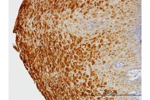 Immunoperoxidase of monoclonal antibody to KRTHB1 on formalin-fixed paraffin-embedded human esophagus.