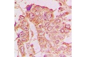 Immunohistochemical analysis of GRASP65 staining in human breast cancer formalin fixed paraffin embedded tissue section. (GORASP1 anticorps)