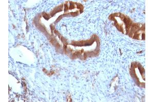 Formalin-fixed, paraffin-embedded human Endometrial Carcinoma stained with Beta-2-Microglobulin Mouse Monoclonal Antibody (B2M/961).