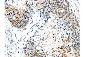 The image on the left is immunohistochemistry of paraffin-embedded Human esophagus cancer tissue using ABIN7131404(TMPRSS4 Antibody) at dilution 1/45, on the right is treated with fusion protein. (TMPRSS4 anticorps)