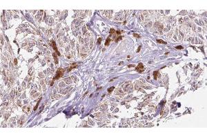 ABIN6275666 at 1/100 staining Human Melanoma tissue by IHC-P. (UEVLD anticorps  (N-Term))