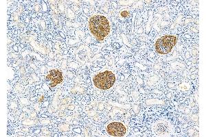 ABIN6260730 and ABIN6279282 at 1/100 staining Human kidney cancer and adjacent normal tissues by IHC-P. (CDR1 anticorps  (N-Term))