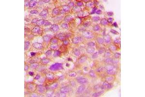 Immunohistochemical analysis of IRS1 (pS307) staining in human breast cancer formalin fixed paraffin embedded tissue section.