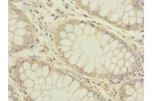 Immunohistochemistry of paraffin-embedded human colon cancer using ABIN7142631 at dilution of 1:100