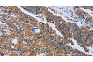 Immunohistochemistry of paraffin-embedded Human ovarian cancer using GAB2 Polyclonal Antibody at dilution of 1:40 (GAB2 anticorps)