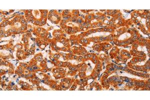 Immunohistochemistry of paraffin-embedded Human thyroid cancer using SLC25A4 Polyclonal Antibody at dilution of 1:40 (SLC25A4 anticorps)