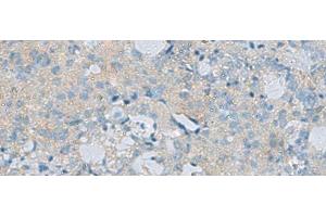 Immunohistochemistry of paraffin-embedded Human ovarian cancer tissue using CDH12 Polyclonal Antibody at dilution of 1:60(x200) (Cadherin 12 anticorps)