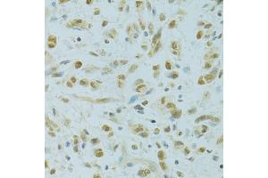 Immunohistochemistry of paraffin-embedded human gastric cancer using RCC1 antibody (ABIN5973761) at dilution of 1/100 (40x lens). (RCC1 anticorps)