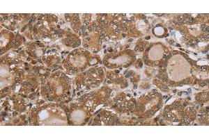 Immunohistochemistry of paraffin-embedded Human thyroid cancer using NDUFS2 Polyclonal Antibody at dilution of 1:35 (NDUFS2 anticorps)