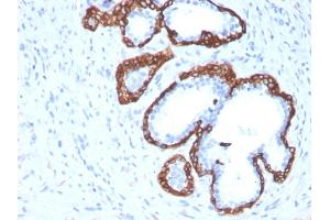 Formalin-fixed, paraffin-embedded human Prostate Carcinoma stained with Cytokeratin 5 Mouse Monoclonal Antibody (KRT5/3594).