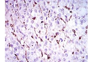 Immunohistochemical analysis of paraffin-embedded liver cancer tissues using NPC1 mouse mAb with DAB staining.
