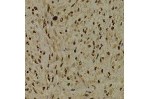 Immunohistochemistry of paraffin-embedded Human adenomyosis using PPP1R8 antibody at dilution of 1:100 (x400 lens). (PPP1R8 anticorps)