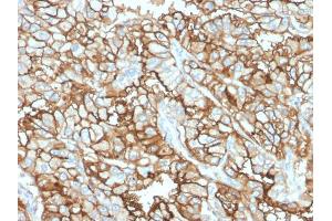 Formalin-fixed, paraffin-embedded human Renal Cell Carcinoma stained with CD10 Mouse Monoclonal Antibody (MME/1870).