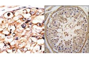 (LEFT)Formalin-fixed and paraffin-embedded human cancer tissue reacted with the primary antibody, which was peroxidase-conjugated to the secondary antibody, followed by AEC staining. (PGK2 anticorps  (N-Term))