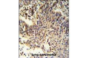 RXRA Antibody IHC analysis in formalin fixed and paraffin embedded lung carcinoma followed by peroxidase conjugation of the secondary antibody and DAB staining. (Retinoid X Receptor alpha anticorps  (AA 196-224))