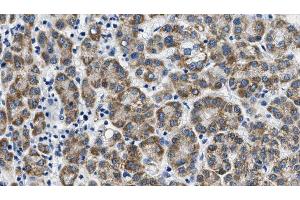 ABIN6268790 at 1/100 staining Human liver cancer tissue by IHC-P. (FSHR anticorps  (Internal Region))