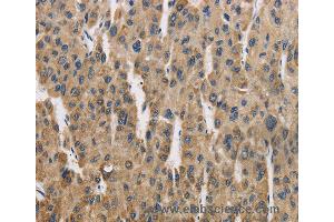 Immunohistochemistry of Human liver cancer using COX6B1 Polyclonal Antibody at dilution of 1:50 (COX6B1 anticorps)