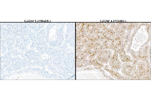 Immunohistochemistry (IHC) image for anti-Carcinoembryonic Antigen-Related Cell Adhesion Molecule 5 (CEACAM5) (AA 35-685) antibody (ABIN7453964)