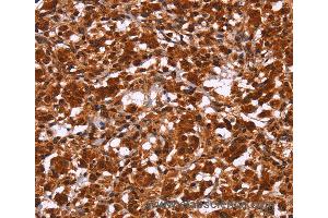 Immunohistochemistry of Human gastric cancer using HIPK1 Polyclonal Antibody at dilution of 1:30