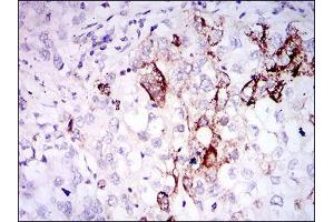Immunohistochemical analysis of paraffin-embedded lung cancer tissues using SST mouse mAb with DAB staining.