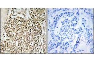 Immunohistochemistry analysis of paraffin-embedded human breast carcinoma, using CEP350 Antibody. (CEP350 anticorps  (AA 671-720))