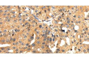 Immunohistochemistry of paraffin-embedded Human breast cancer tissue using SH3KBP1 Polyclonal Antibody at dilution 1:45 (SH3KBP1 anticorps)