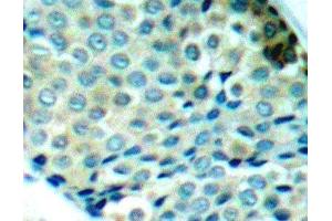 Immunohistochemistry of paraffin-embedded Human breast carcinoma using Phospho-HSPB1(S78) Polyclonal Antibody (HSP27 anticorps  (pSer78))
