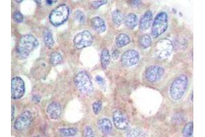 Immunohistochemistry analyzes of p70 S6K antibody in paraffin-embedded human breast carcinoma tissue. (RPS6KB1 anticorps)