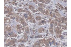 DAB staining on IHC-P; Samples: Human Breast cancer Tissue (GBP4 anticorps  (AA 1-292))