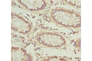 Immunohistochemistry of paraffin-embedded human colon cancer using ABIN7164553 at dilution of 1:100 (LARS2 anticorps  (AA 1-250))