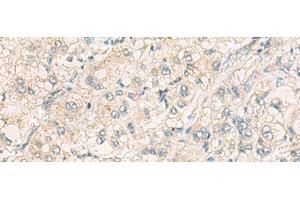 Immunohistochemistry of paraffin-embedded Human liver cancer tissue using THG1L Polyclonal Antibody at dilution of 1:70(x200) (THG1L anticorps)