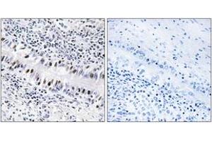 Immunohistochemistry analysis of paraffin-embedded human lung carcinoma, using ZNF76 Antibody. (ZNF76 anticorps  (AA 116-165))
