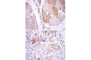 Immunohistochemical analysis of paraffin-embedded human muscle (upper) and human lung cancer (bottom) tissues using IL1B monoclonal antibody, clone 3A6  with DAB staining. (IL-1 beta anticorps)